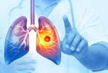 Her Yıl 25 Bin Akciğer Kanseri Vakası Önlenebilir